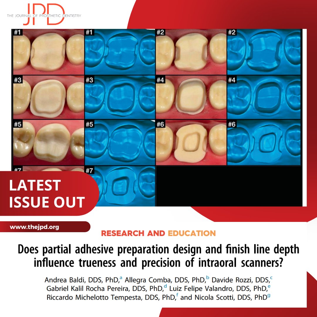 JPDentistry's tweet photo. This #invitrostudy from #theJPD examines the #accuracyandprecision of different #intraoralscanners when scanning complex #toothpreparation configurations that integrate special #toothmargin designs with #interproximal boxes and #endocrown incorporation: https://t.co/inEZ1p2QA5 https://t.co/jXEnjG42I0