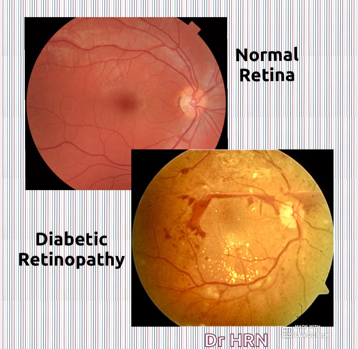 This is what #Diabetes does to your eyes #diabeticretinopathy 

Five steps you should take to save your vision 👇🏻

#Saveyoursight #retina #healthcare