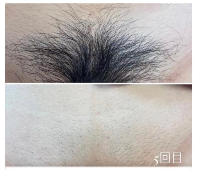 数年前からメンズでも髭やVIO脱毛してる人が増えて来てるけど、こちらは1年半ぐらい掛けてレーザーや光脱毛でほぼ完了して全身ツルッツル笑  ただ以前は女性ですらパイパンでVIOが無毛だとなんで!?て思ってたぐらいで常識なんてそんな程度&hellip;マスクしてない事が常識で連休明けに5類へ下がるし元へ戻れ<a href="/tag/%E3%81%BE%E3%82%93%E6%8B%93"class="tags"><span>#まん拓</span></a><a href="/tag/%E3%81%A1%E3%82%93%E6%8B%93"class="tags"><span>#ちん拓</span></a><a href="/tag/vaginaprint"class="tags"><span>#vaginaprint</span></a><a href="/tag/penisprint"class="tags"><span>#penisprint</span></a>