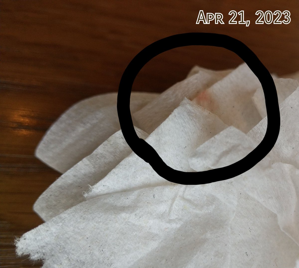 NozomiN9999's tweet image. 執拗な奇行集団によるattacks between legsでうっすらだが出血。昨年か、以前に80回近くの攻撃で不正出血した子宮とは異なる。

#ElectromagneticWave 
#集団ストーカー