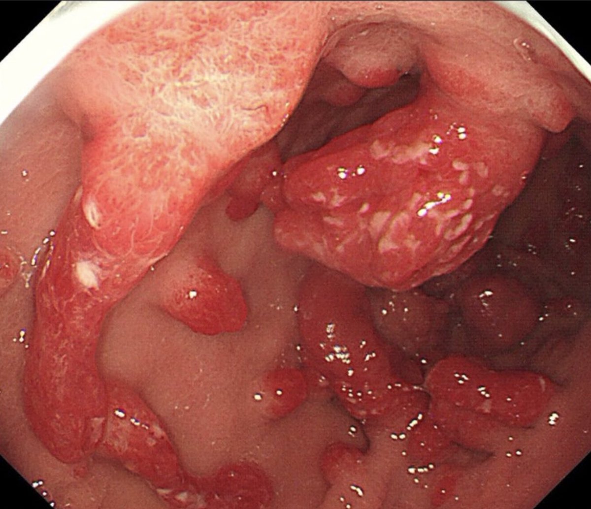 DrShady_Yousif's tweet photo. @drkeithsiau 💠Gastric hyperplastic polyps (GHPs).
✅Dx:
1️⃣“Strawberry-like” appearance with erosions of polyps.
2️⃣With potential risk of neoplastic transformation.
3️⃣Risk factors for GHPs:
☑Anaemia.
☑Autoimmune metaplastic atrophic gastritis (AMAG). https://t.co/gGEjqKPDJb