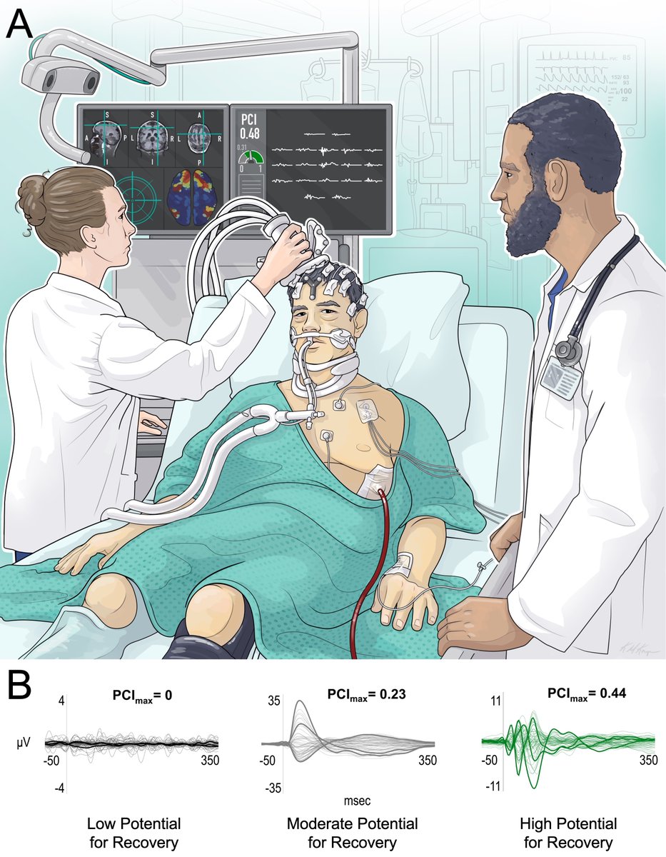 What is the best test to detect consciousness in the ICU? Behavioral exam? fMRI? EEG? Or is it TMS-EEG? We discuss the potential for TMS-EEG measurements of brain complexity to improve care for patients with severe brain injuries in the ICU. link.springer.com/article/10.100… @CuringComa