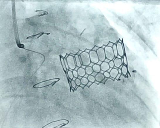 adgpi's tweet photo. #WeCare
In a First, Pediatric Cardiology Team of Army Hospital (R &amp; R), #NewDelhi replaced a heart valve without surgery, using a unique technique in a patient. The Patient had developed severe leakage in one of the heart valves following an open heart surgery in early childhood. https://t.co/HDK0SL2zxN