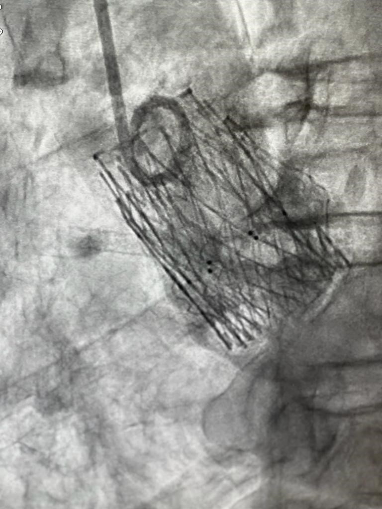 BiosensorsLtd's tweet photo. First Perceval S VIV case performed with #ALLEGRA™ 23 and one #BioFreedom™ ULTRA  3,5 x 19 stent in the RCA, Hospital La Fe, Valencia. Congrats to Dr Jose Luis Diez, Dr Jorge Sanz Sánchez Sanz, Dr Pablo Aguar and  team!! Final result with no PVL and a post gradient of 5 mmHg. https://t.co/7tr2WlS2gh