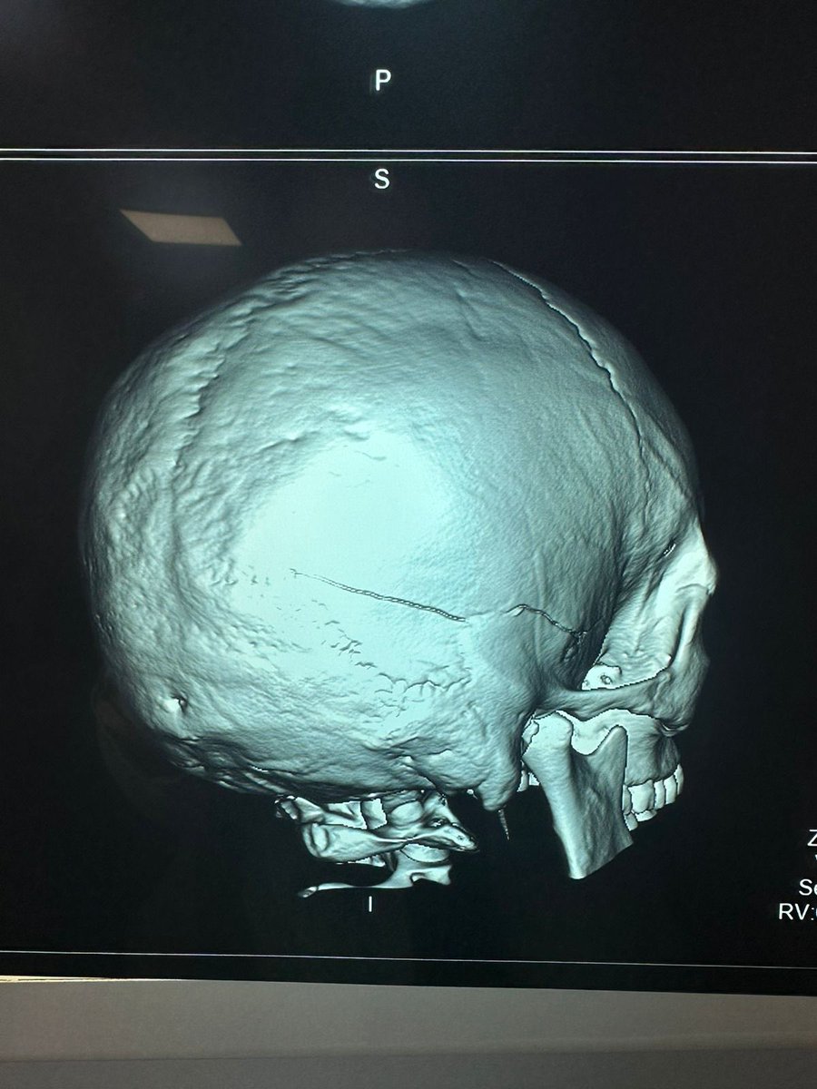 KMaragao's tweet photo. El día de hoy mientras mi primo corría fue atropellado por este poco hombre y ser humano. Nunca se acercó a dar unas disculpas, nunca se acercó a preguntar cómo estaba…NADA. Simplemente se escondió mientras mi primo estaba en el hospital desorientado, con el cráneo fracturado… https://t.co/6Euf2D03Qe