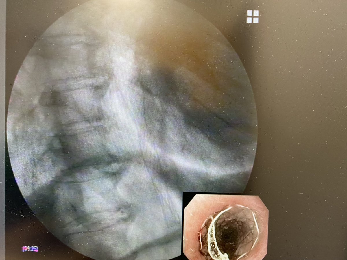 Últimos pasitos de la mano de <a href="/abbwonderland/">Alicia Brotons</a> y Javier Sola-Vera… prótesis de esófago parcialmente recubierta en estenosis maligna ✌️✔️
#womeninendoscopy #HGUE