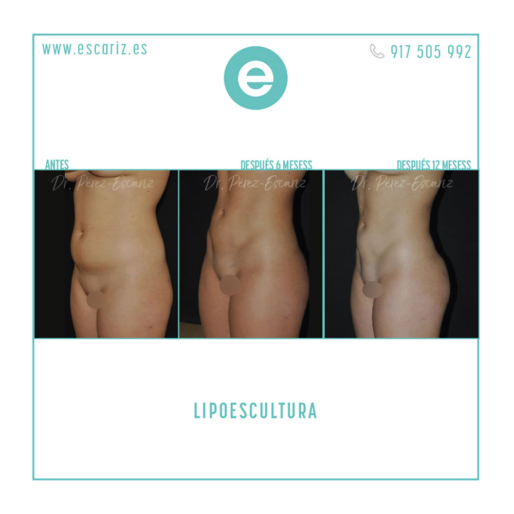 DrPerezEscariz's tweet photo. En este caso, el Dr. Escariz realizó una lipoescultura de abdomen, flancos y glúteos, usando la tecnología de #Bodytite.  Con unos resultados casi inmediatos, que pueden ir mejorando  con el paso del tiempo.

#cirugíaplástica #cirugíaestética #liposucción #lipoescultura https://t.co/RC1mB5ibFc