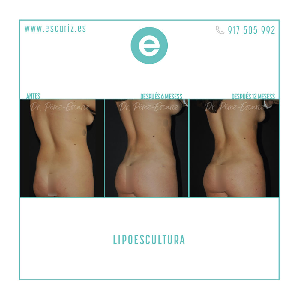 DrPerezEscariz's tweet photo. En este caso, el Dr. Escariz realizó una lipoescultura de abdomen, flancos y glúteos, usando la tecnología de #Bodytite.  Con unos resultados casi inmediatos, que pueden ir mejorando  con el paso del tiempo.

#cirugíaplástica #cirugíaestética #liposucción #lipoescultura https://t.co/RC1mB5ibFc