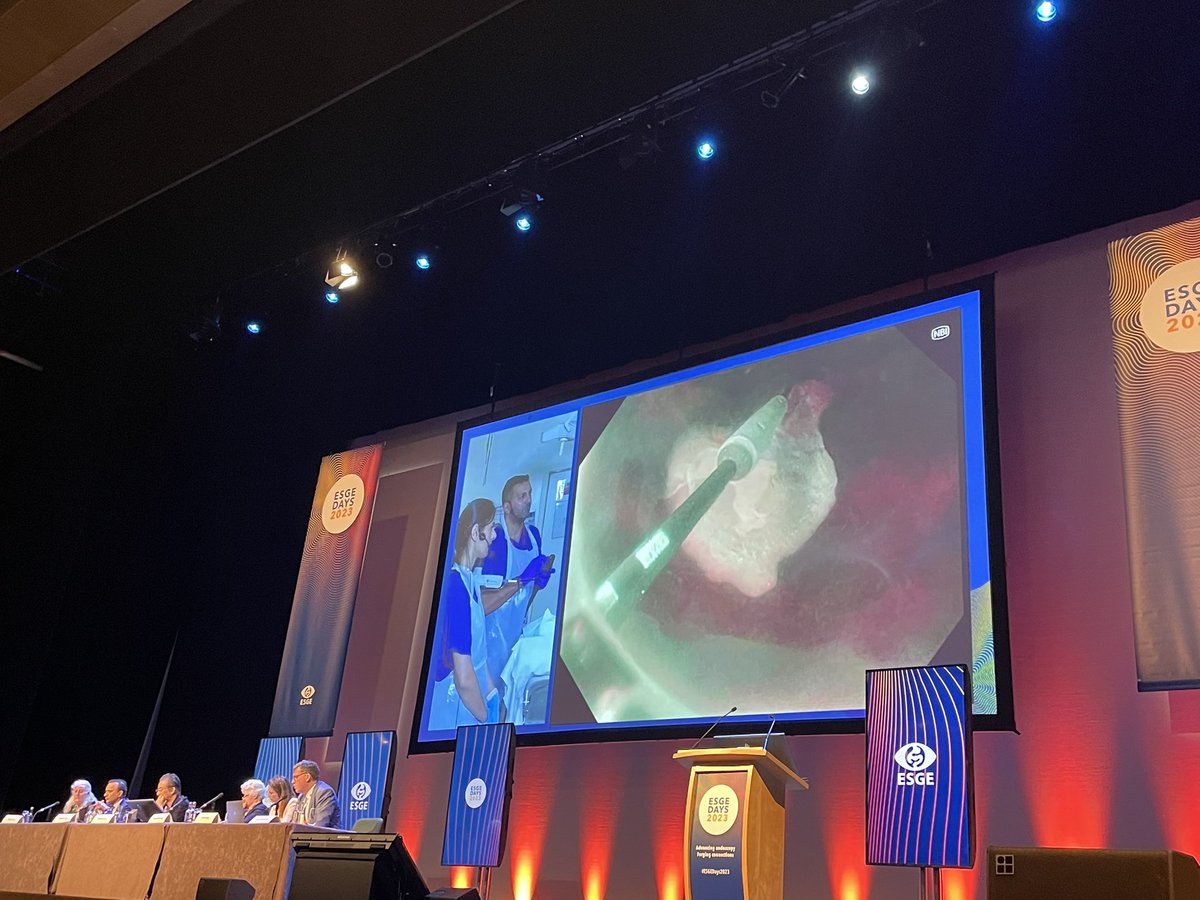 Hein_Gastro's tweet photo. Beautiful demonstration of a C2 CryoBalloon . Another choice in the growing treatment armamentarium of Barrett’s Endotherapies. 
#ESGEDays2023 @PENTAXMedicalUK @PUK_idrisbora https://t.co/9l4xDnPUK2