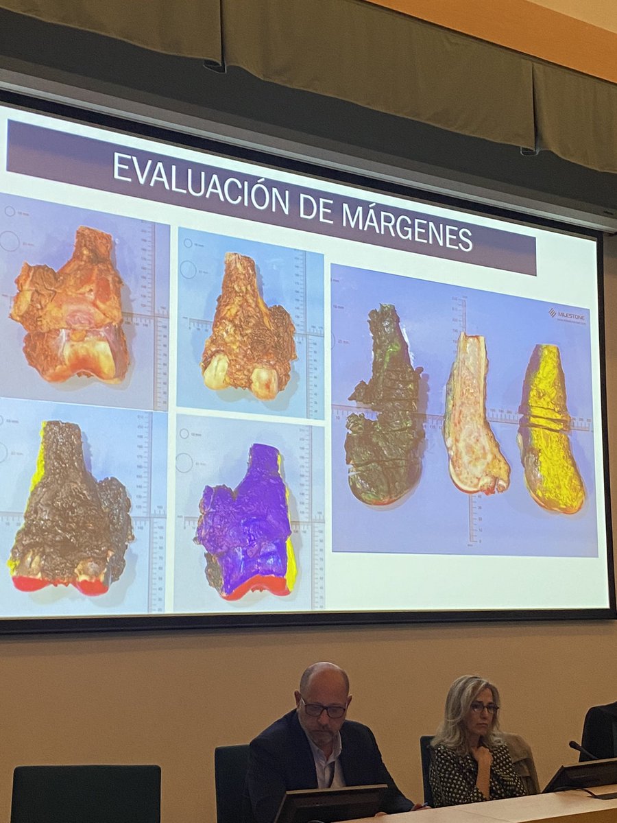 SarcomasAEC's tweet photo. Amazing talk about pathological diagnosis and margins evaluation in soft tissue sarcomas by Dra. Lopez. Congratulations! @ipolisboa #pathology #sarcoma #margins https://t.co/GJ3kumkGGZ