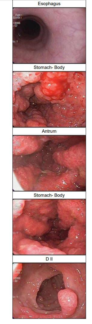 drgopalparikh's tweet photo. 67 female polypoidal gastric and duodenal lesion ?/mlg
#GIpath #RaulGonzalez #RhondaSantis #PathTwitter https://t.co/mhmfNZClO9