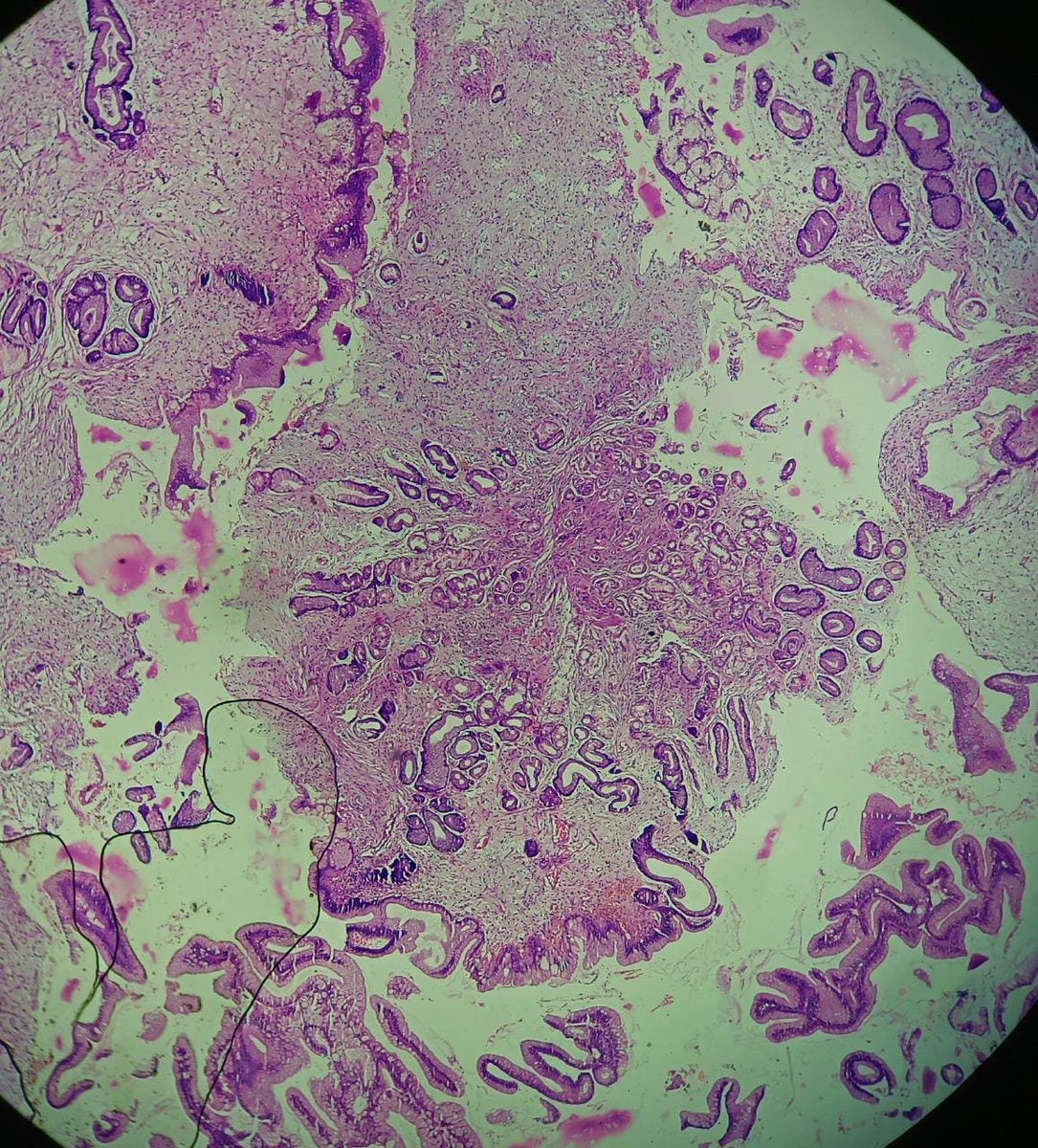 drgopalparikh's tweet photo. 67 female polypoidal gastric and duodenal lesion ?/mlg
#GIpath #RaulGonzalez #RhondaSantis #PathTwitter https://t.co/mhmfNZClO9