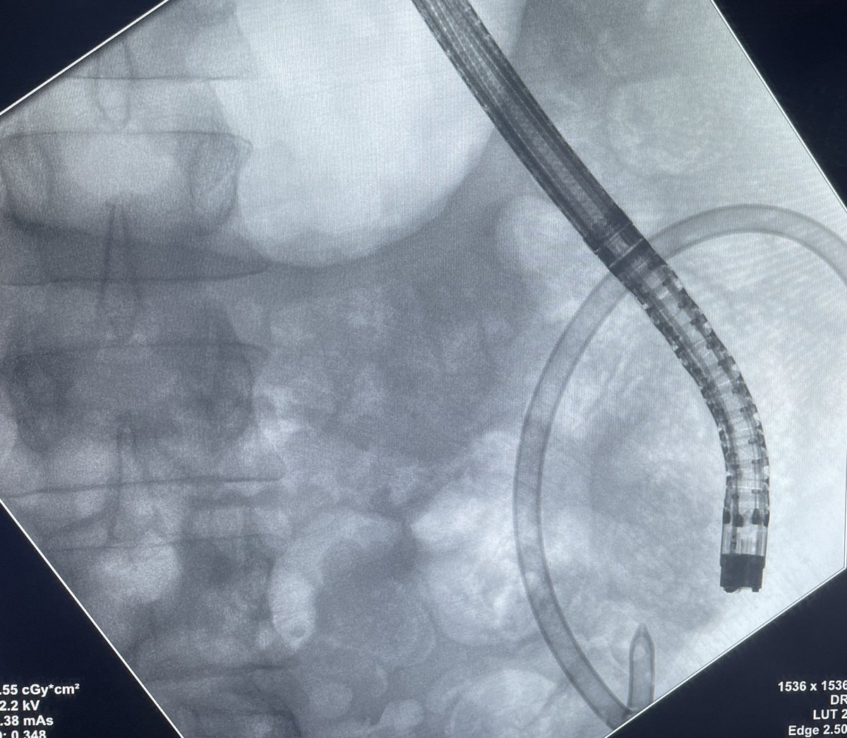 AymericBecq's tweet photo. When endoscopic necrosectomy meets radiologic drainage 😅 very severe AP case with massive pelvic necrosis. Let’s hope he won’t end up with a chronic fistula 😨 #GITwitter #endoscopy @GHUMondor https://t.co/KysPQv1xFJ