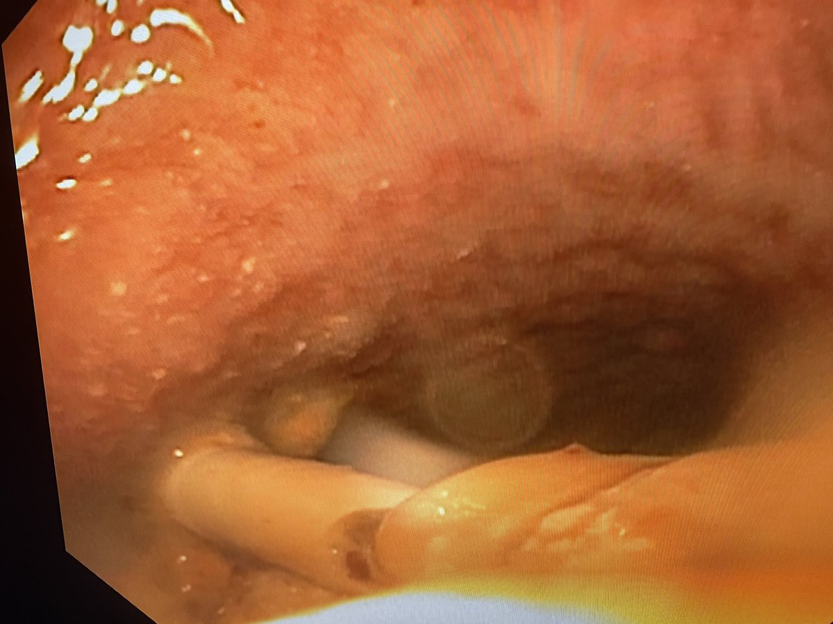 AymericBecq's tweet photo. When endoscopic necrosectomy meets radiologic drainage 😅 very severe AP case with massive pelvic necrosis. Let’s hope he won’t end up with a chronic fistula 😨 #GITwitter #endoscopy @GHUMondor https://t.co/KysPQv1xFJ