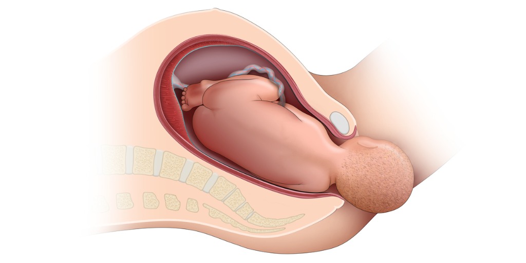 Maybe #cesareandelivery should not be the default delivery method for most pregnancies carrying an infant with #achondroplasia #vaginaldelivery #prenatalgenetics <a href="/DrBobbyBrar/">Bobby Brar</a> bit.ly/3H7Y97F