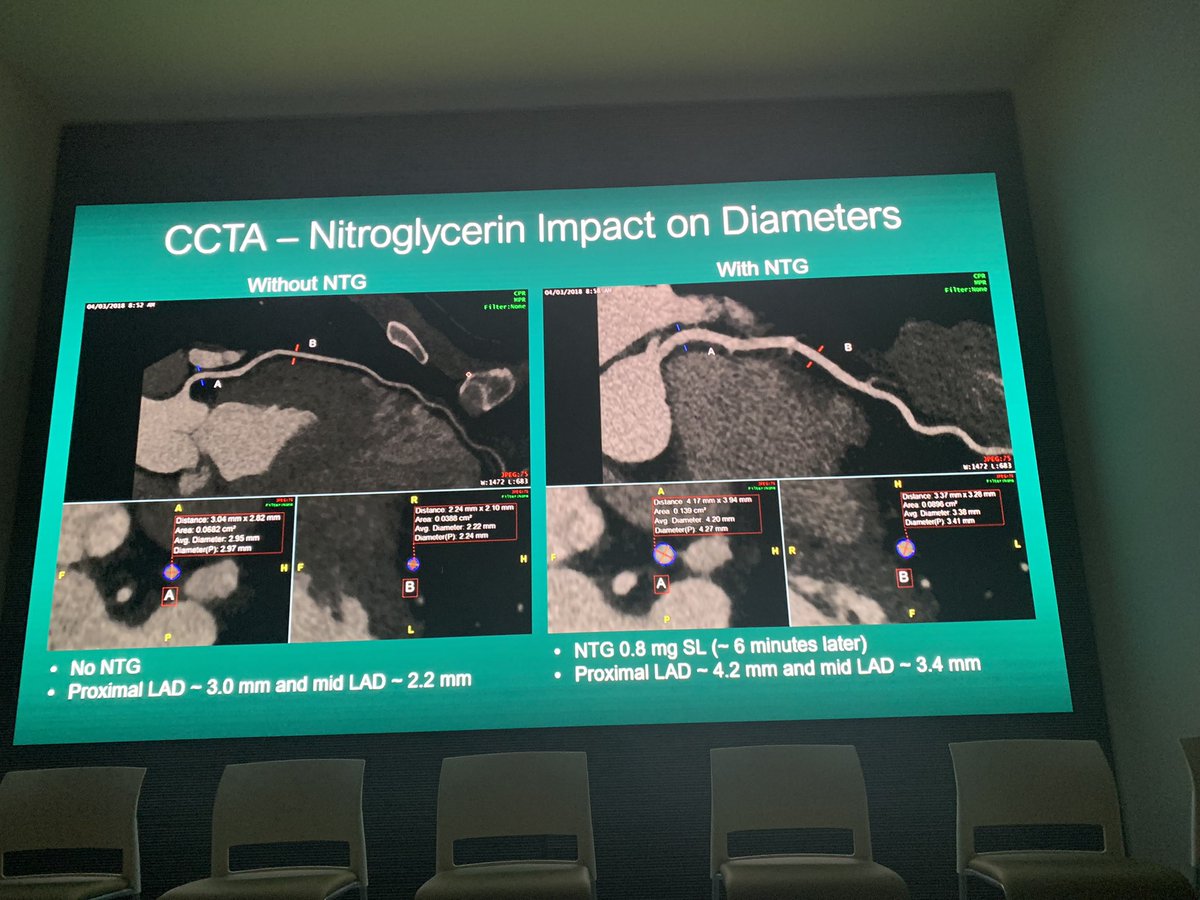 drmalissawood's tweet photo. @MarkusSchererMD eloquently discussing role of cardiac CTA in SCAD โYou donโt know what you canโt seeโ #SangerSCADConference @SCADalliance @iSCADregistry @EstherSHKimMD https://t.co/jP4FpwL9M8