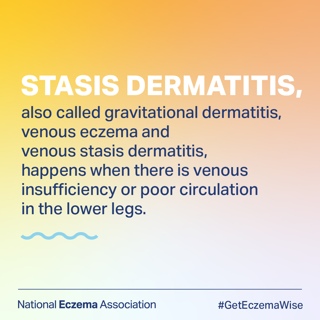 nationaleczema's tweet photo. #Stasisdermatitis affects people with poor circulation, and occurs more often in women. Treatments for this type of #eczema include surgery to repair damaged veins, pressure stockings, and topicals.
https://t.co/3ktZTqOwkd
#GetEczemaWise #dermtwitter https://t.co/VrkkxNYHzL