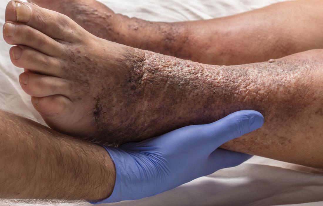 nationaleczema's tweet photo. #Stasisdermatitis affects people with poor circulation, and occurs more often in women. Treatments for this type of #eczema include surgery to repair damaged veins, pressure stockings, and topicals.
https://t.co/3ktZTqOwkd
#GetEczemaWise #dermtwitter https://t.co/VrkkxNYHzL