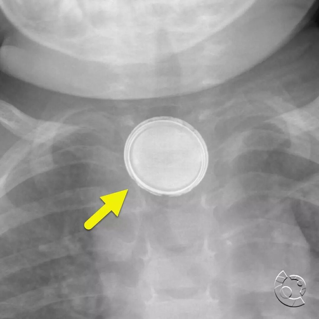 CincyKidsRad's tweet photo. AP (image 1) and lateral (image 2) radiograph of the airway showing ingested button battery (button batter) with erosion of the inferior margin. The battery is causing significant edema. This is seen on the lateral view where there is widening of the spa… https://t.co/9QGoI3nPPQ https://t.co/i4Wm8fmL8s
