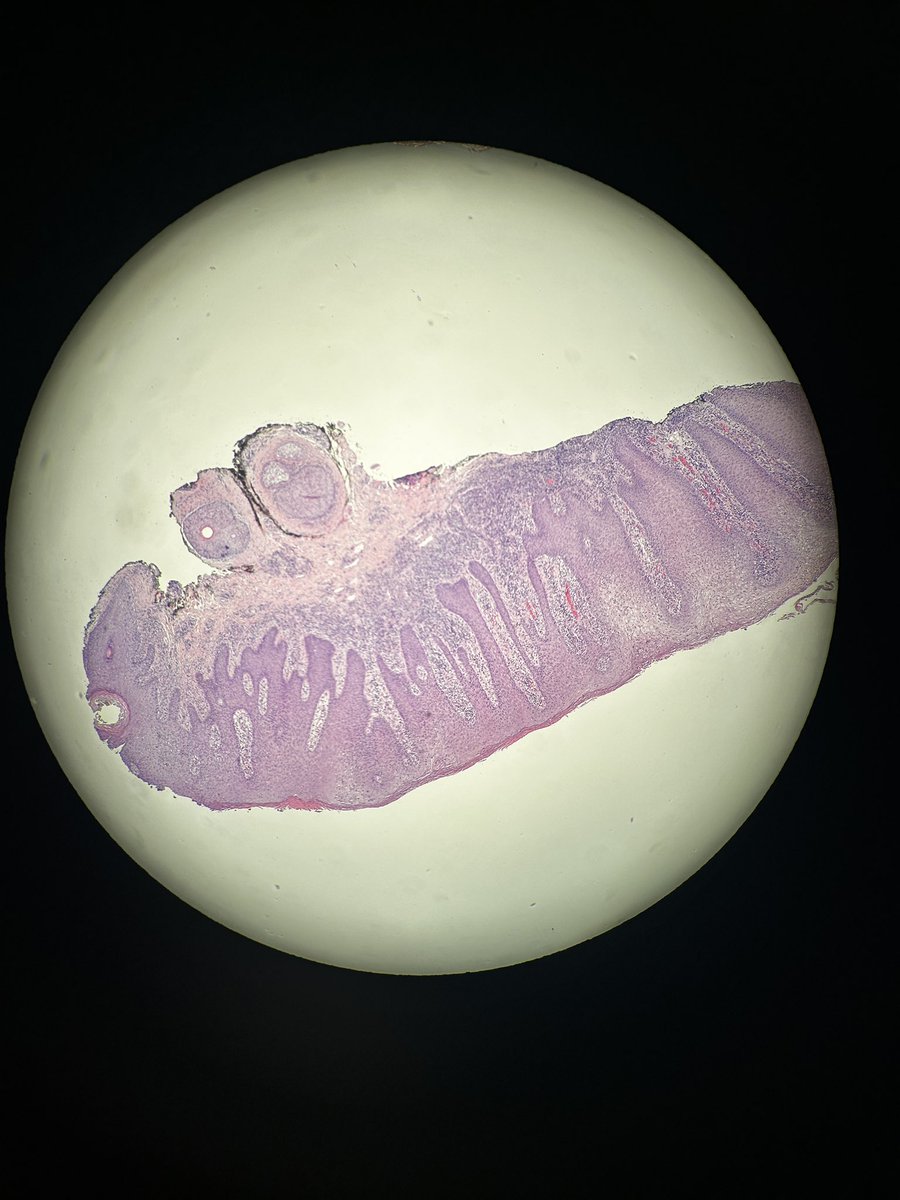 Path4People's tweet photo. Uncovering a Syphilis diagnosis through histology? Our latest #casestudyfriday highlights the importance of thorough investigation in detecting hidden diseases. Don't underestimate the power of pathology in uncovering the truth! ๐ง๐ฌ #Path4People (rash is not actual pt photo). https://t.co/hVXfa2BagV