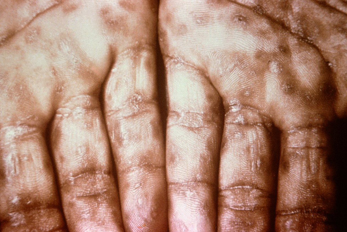 Path4People's tweet photo. Uncovering a Syphilis diagnosis through histology? Our latest #casestudyfriday highlights the importance of thorough investigation in detecting hidden diseases. Don't underestimate the power of pathology in uncovering the truth! ๐ง๐ฌ #Path4People (rash is not actual pt photo). https://t.co/hVXfa2BagV