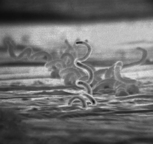 Path4People's tweet photo. Uncovering a Syphilis diagnosis through histology? Our latest #casestudyfriday highlights the importance of thorough investigation in detecting hidden diseases. Don't underestimate the power of pathology in uncovering the truth! ๐ง๐ฌ #Path4People (rash is not actual pt photo). https://t.co/hVXfa2BagV