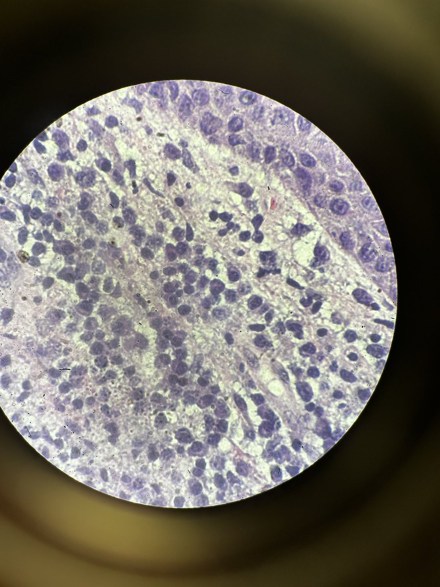Path4People's tweet photo. Uncovering a Syphilis diagnosis through histology? Our latest #casestudyfriday highlights the importance of thorough investigation in detecting hidden diseases. Don't underestimate the power of pathology in uncovering the truth! ๐ง๐ฌ #Path4People (rash is not actual pt photo). https://t.co/hVXfa2BagV