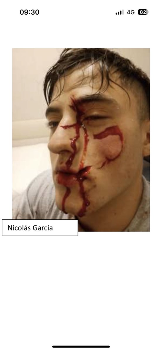 pampamonaco's tweet photo. Se viene un pedido de jury para un juez por la liberación de un detenido.
Nicolas García fue atacado por Santiago Martinez en un boliche de Villa Tesei. El joven perdió un ojo y quedó desfigurado.
El agresor recibió la liberación sin pulsera electronica y sin resolución firme https://t.co/v24lyBH9yr