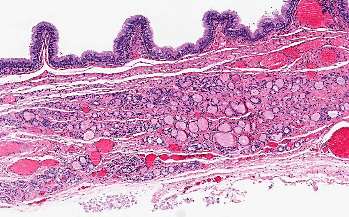 NHardy_path's tweet image. Thyroglossal duct cyst in all its undulating ciliated beauty. Too perfect not to share #beautyinthebenign