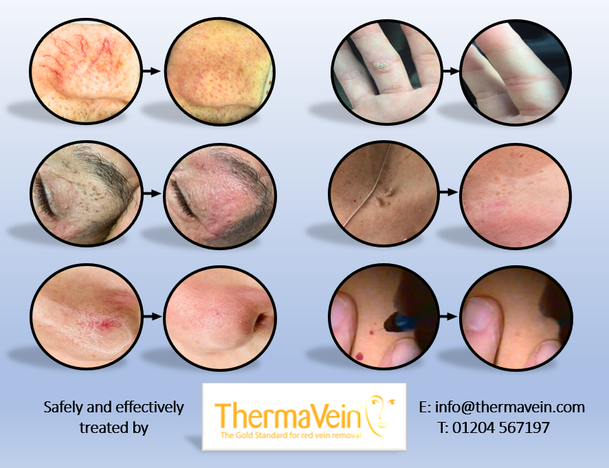 thermavein's tweet photo. It's Friday! Let us treat you to a few fantastic before and after pictures courtesy of our wonderful customers
For more info contact info@thermavein.com
#thermavein #friday #beauty #aesthetics #threadveins #spiderveins #redveins #milia #skintags #warts #IPL #Laser #FridayVibes https://t.co/SMvC10SjxW
