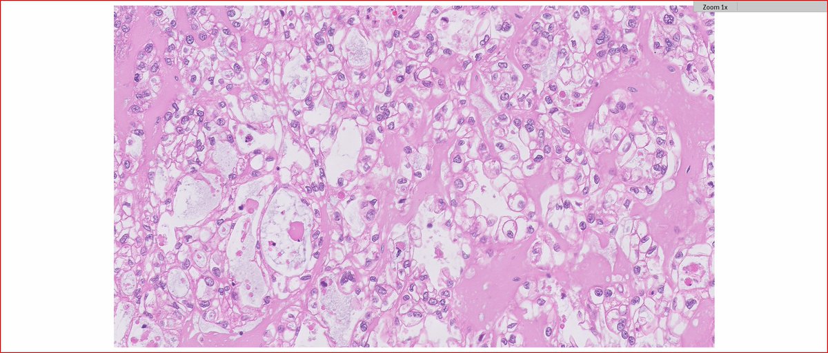IGCS (@igcsociety) on Twitter photo Happy Friday! Our first #IGCSPathPoll is: Endometrial tumor in a postmenopausal patient with thromboembolism... Happy Friday! Our first #IGCSPathPoll is: Endometrial tumor in a postmenopausal patient with thromboembolism...