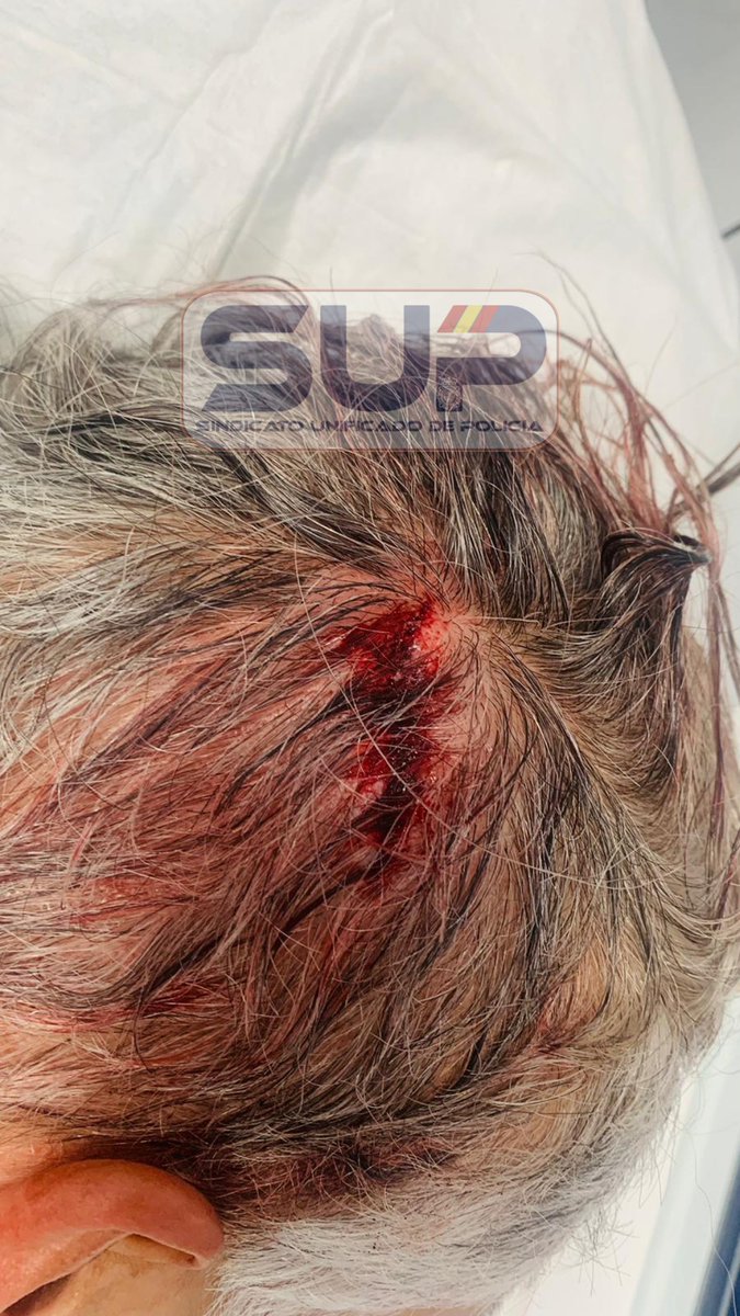 Sup_Policia's tweet photo. Deseamos #ProntaRecuperación a nuestro #compañero agredido brutalmente en Alcantarilla, #Murcia 
#FueraDeServicio asistía a una mujer que sufrió un robo en su vehículo
Fue agredido por 3 hombres en las inmediaciones
Tiene todo el apoyo de nuestro #GabineteJurídico de @SUP_Murcia https://t.co/UD0Y5yy8uA