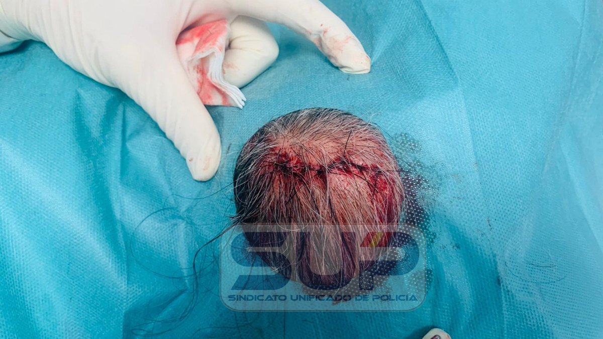 Sup_Policia's tweet photo. Deseamos #ProntaRecuperación a nuestro #compañero agredido brutalmente en Alcantarilla, #Murcia 
#FueraDeServicio asistía a una mujer que sufrió un robo en su vehículo
Fue agredido por 3 hombres en las inmediaciones
Tiene todo el apoyo de nuestro #GabineteJurídico de @SUP_Murcia https://t.co/UD0Y5yy8uA