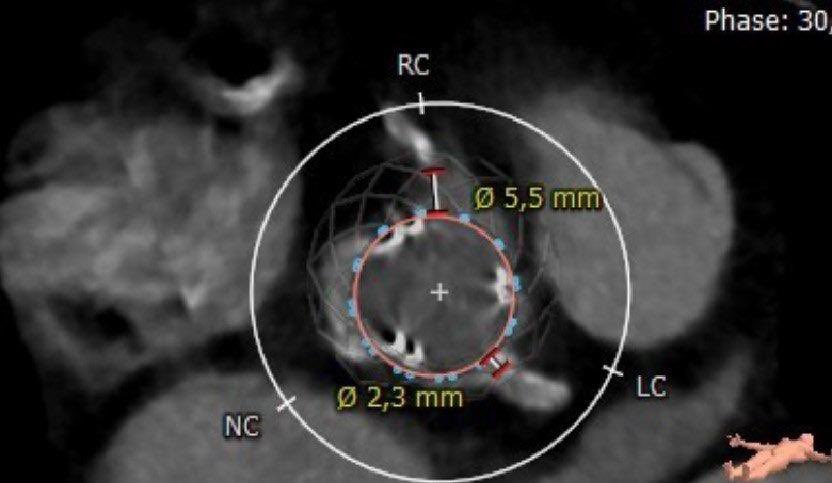 CuissetDr's tweet photo. First case of BASILICA (with double “protection “) at Timone Hospital Marseille for VinV with very high risk of LM occlusion (No TF access !) thanks to support of our Friend @CSaintEtienne 
@deharo_pierre @nicolasdumonte1 @PCRonline @aphm_actu https://t.co/5PqvrvhRct