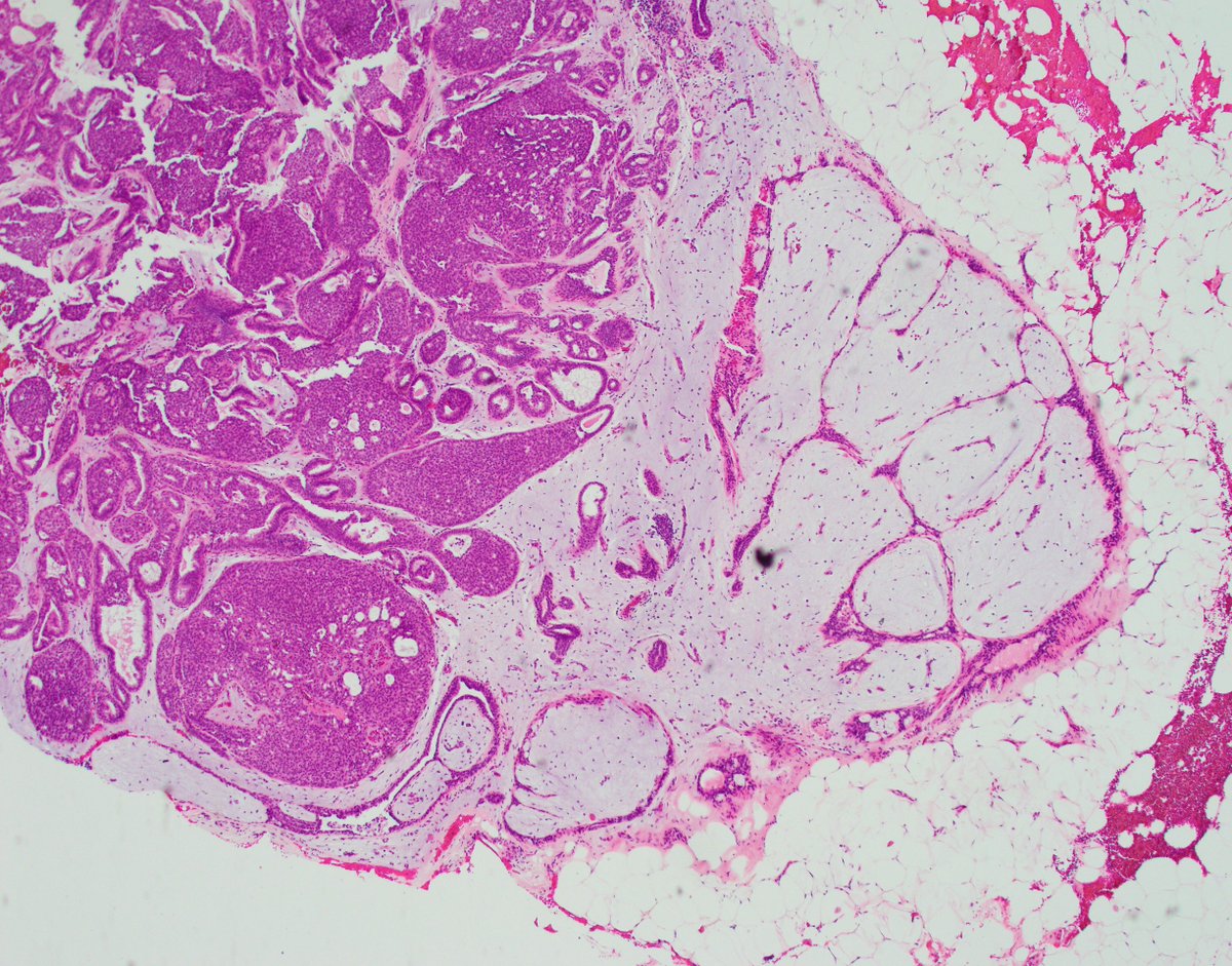 fouad_boulos's tweet photo. Friday cuteness. Some cases are just visually appealing aside from being diagnostically challenging. This is an example of a fibroadenoma involved by an expansile and somewhat uniform pattern of usual ductal hyperplasia, the most florid example I have seen within a fibroadenoma. Fortunately, CK5/6 accentuated the mixed nature of the proliferation and saved the day :) @wusm_pathology @washupathedu #PathTwitter #BreastPath