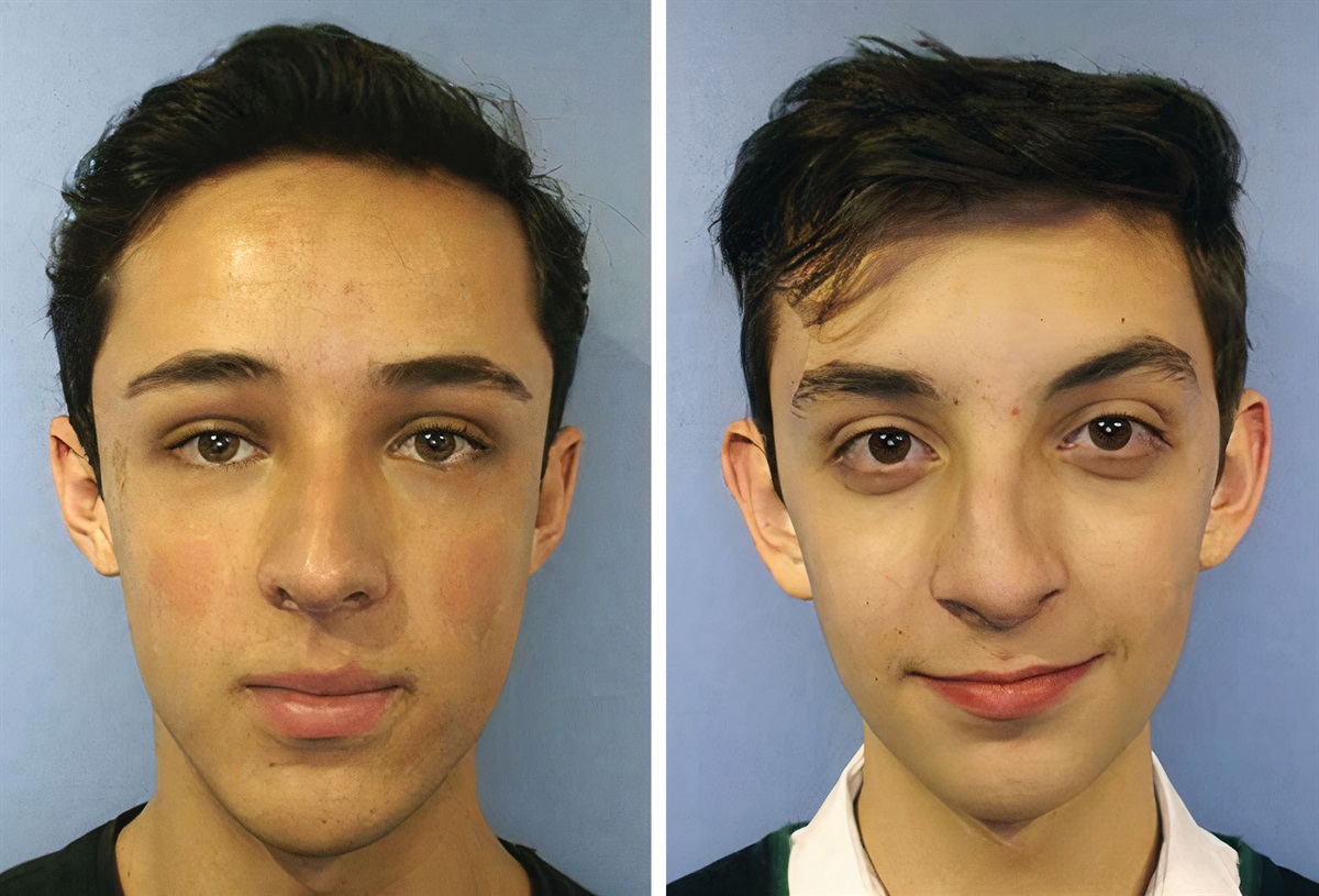 Trending in PRS Twisted Nose: Preservation Rhinoplasty with Modified Push-Down/Let-Down Technique dlvr.it/SmrvD8