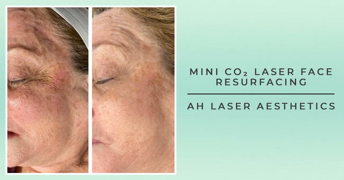 AHLaser's tweet photo. Did you know existing AH Laser customers receive a #birthday gift?

Enjoy 20% off services and products and 10% off #injectables during your birthday month 🎂 Contact our team to learn more!

📞 (847) 255-7474
💻 https://t.co/VGUXvDU1ip

#Aesthetics #Specials #Beauty #Fillers https://t.co/GZGCz3Sh8M