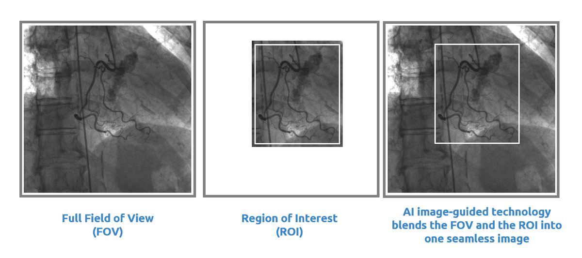 OmegaCardiac's tweet photo. What does Region of Interest (#ROI) #technology mean to you? #NextLevel imaging where #radiation is directed to an anatomical target (ROI) as needed for a case while reducing #RadiationExposure to surrounding tissue. #RadiationReduction with proven results! #CardioTwitter #EPeeps https://t.co/kngzUHRdK8