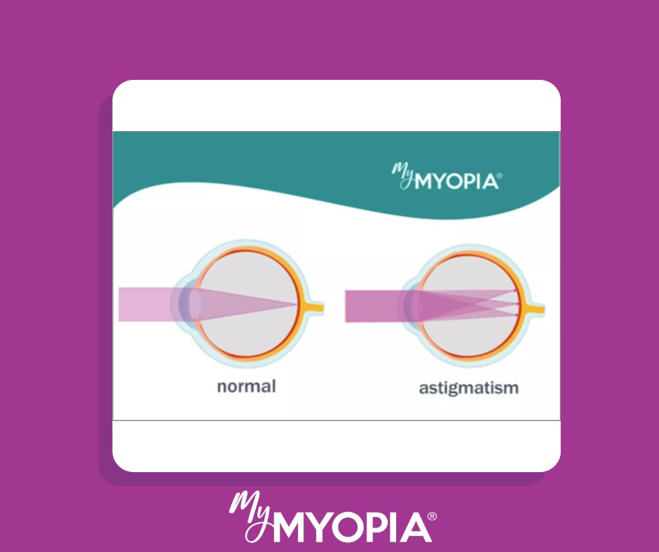 Our kids eye health glossary helps parents like you understand vision terms and eye conditions. The glossary word of the day is Astigmatism. Check out more glossary terms here: mymyopia.com/glossary/