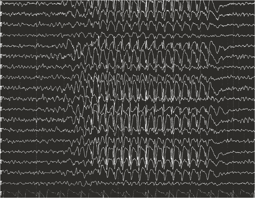 MedcasesA's tweet photo. 8y/o F patient presents for EEG after periods of altered consciousness. During hyperventilation test, noted generalized discharges of high-voltage 3 Hz spike-wave bands. Suspected #Epilepsy? Further investigation & treatment needed. #neurology #pediatrics #EEGtest https://t.co/56jSnCklmC