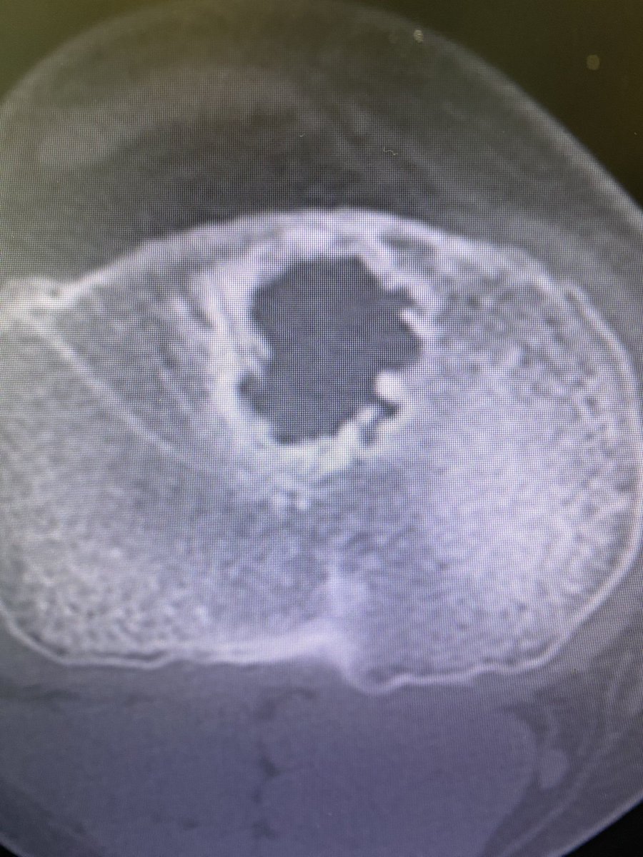 DrNickColyvas's tweet photo. Bioabsorbable screw.  Just say no

#revisionACL https://t.co/KPZyhnhtBZ