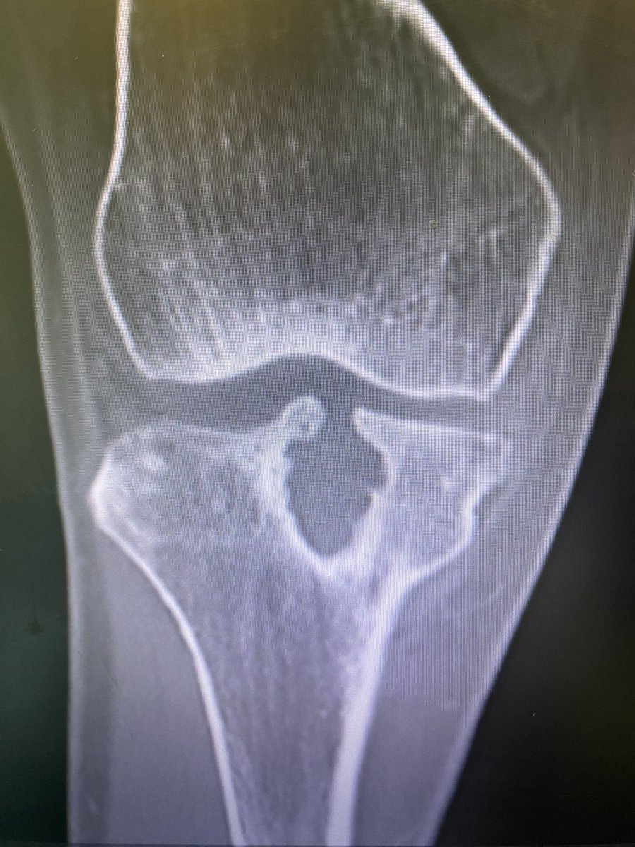DrNickColyvas's tweet photo. Bioabsorbable screw.  Just say no

#revisionACL https://t.co/KPZyhnhtBZ