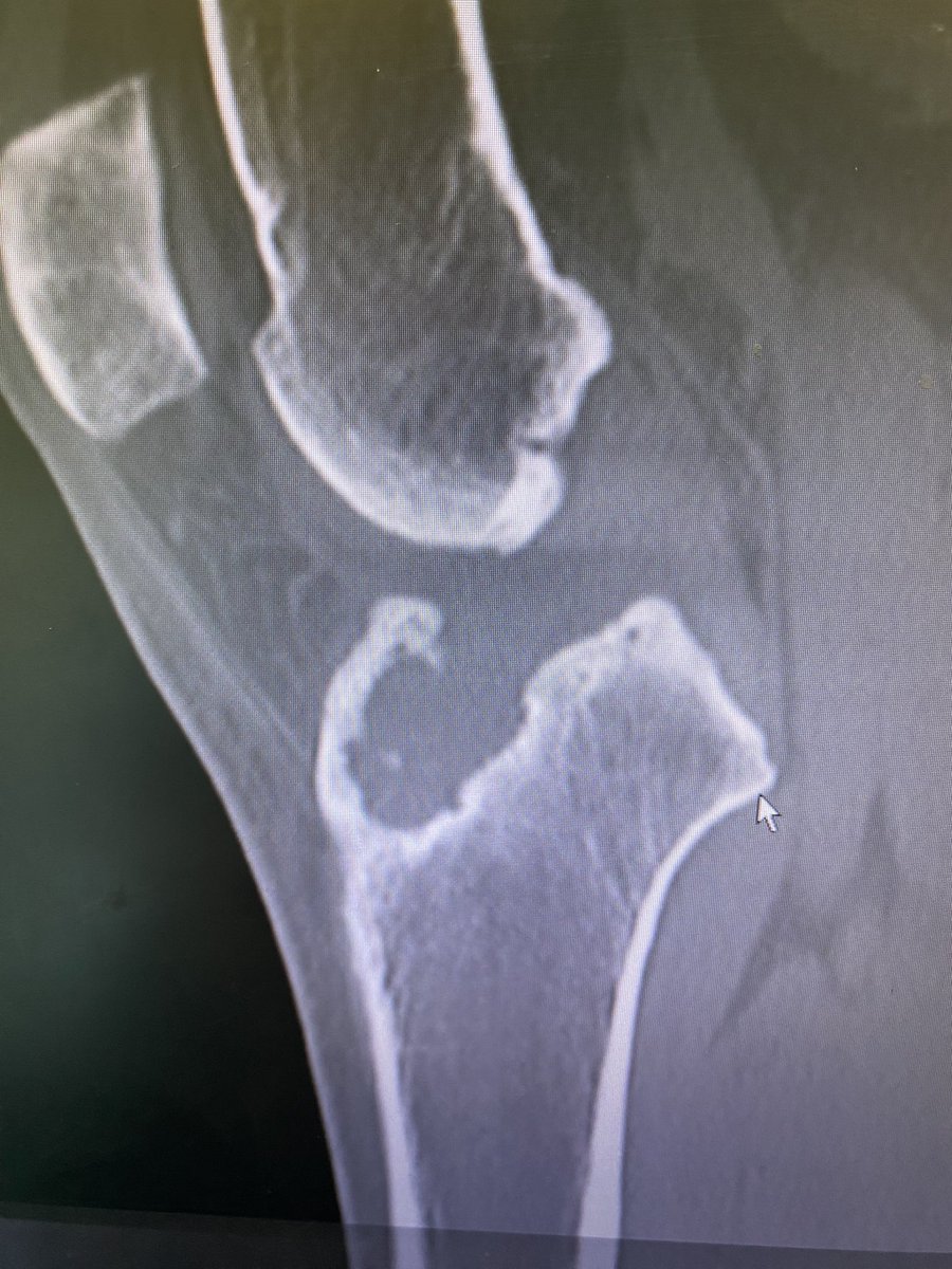DrNickColyvas's tweet photo. Bioabsorbable screw.  Just say no

#revisionACL https://t.co/KPZyhnhtBZ