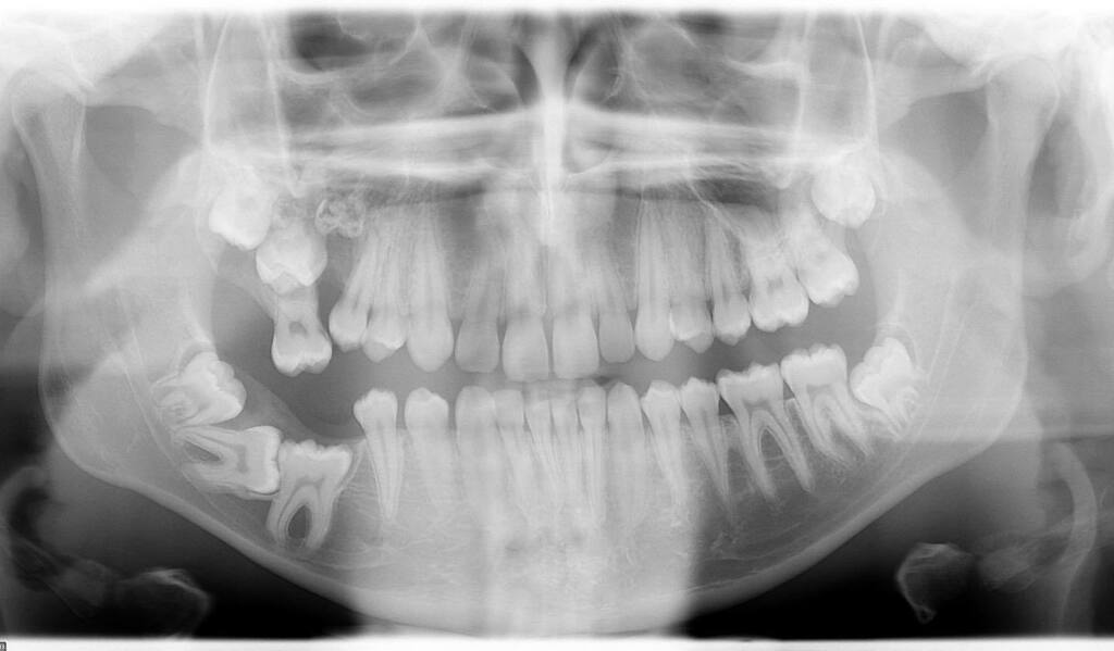 picassoortho's tweet photo. How many things are not normal in this X-ray? 🤓
•

•

•
#picasso #picassoortho #orthodontist #orthodontics #dentist #dental #health #healthcare #healthy #doctor #doctors #happy #love #patient #smile #teeth #teethwhitening #braces #invisalign #awesome #cool #fun #instagoo… https://t.co/oiq6iEGyaF