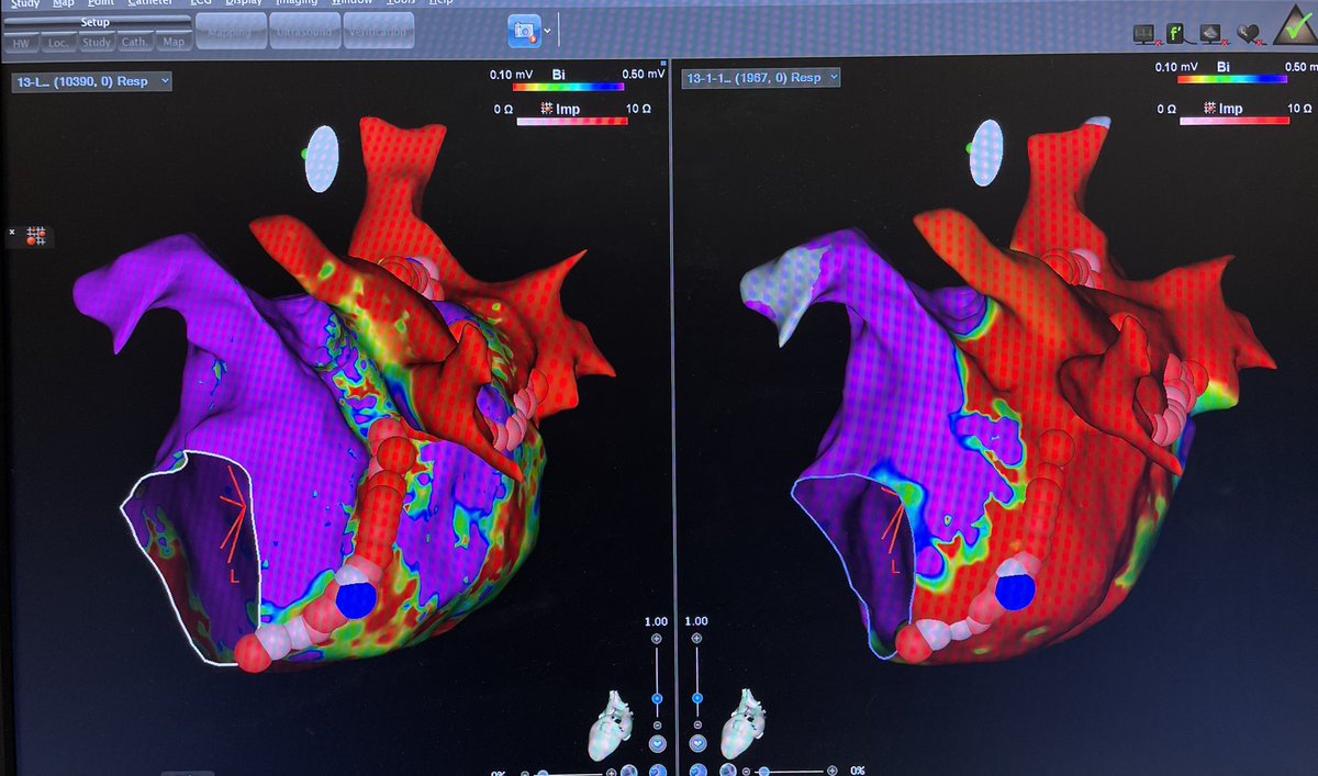 Sei Iwai (@seiiwaiepmd) on Twitter photo Our 1st Vein of Marshall ablation (pre- and post- images). Worked great! Thanks to @MiguelVldrbno for showing us the way! 🙏<a href="/SrihariNaiduMD/">Srihari S. Naidu, MD</a> <a href="/DrRhthm/">Jason Jacobson</a> <a href="/DanFrenkelMD/">Dan Frenkel</a> @WestchesterMed #VOM #EPeeps #CardioTwitter Our 1st Vein of Marshall ablation (pre- and post- images). Worked great! Thanks to @MiguelVldrbno for showing us the way! 🙏<a href="/SrihariNaiduMD/">Srihari S. Naidu, MD</a> <a href="/DrRhthm/">Jason Jacobson</a> <a href="/DanFrenkelMD/">Dan Frenkel</a> @WestchesterMed #VOM #EPeeps #CardioTwitter