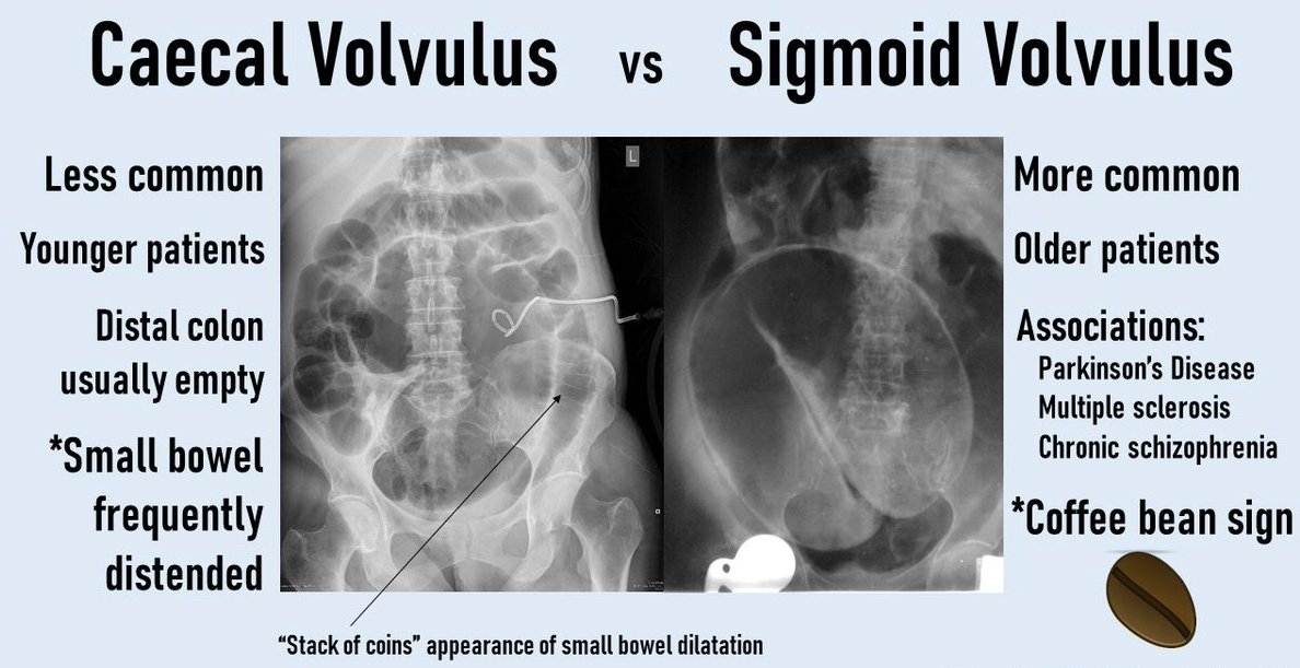 Sigmoid Volvulus Coffee Bean Sign