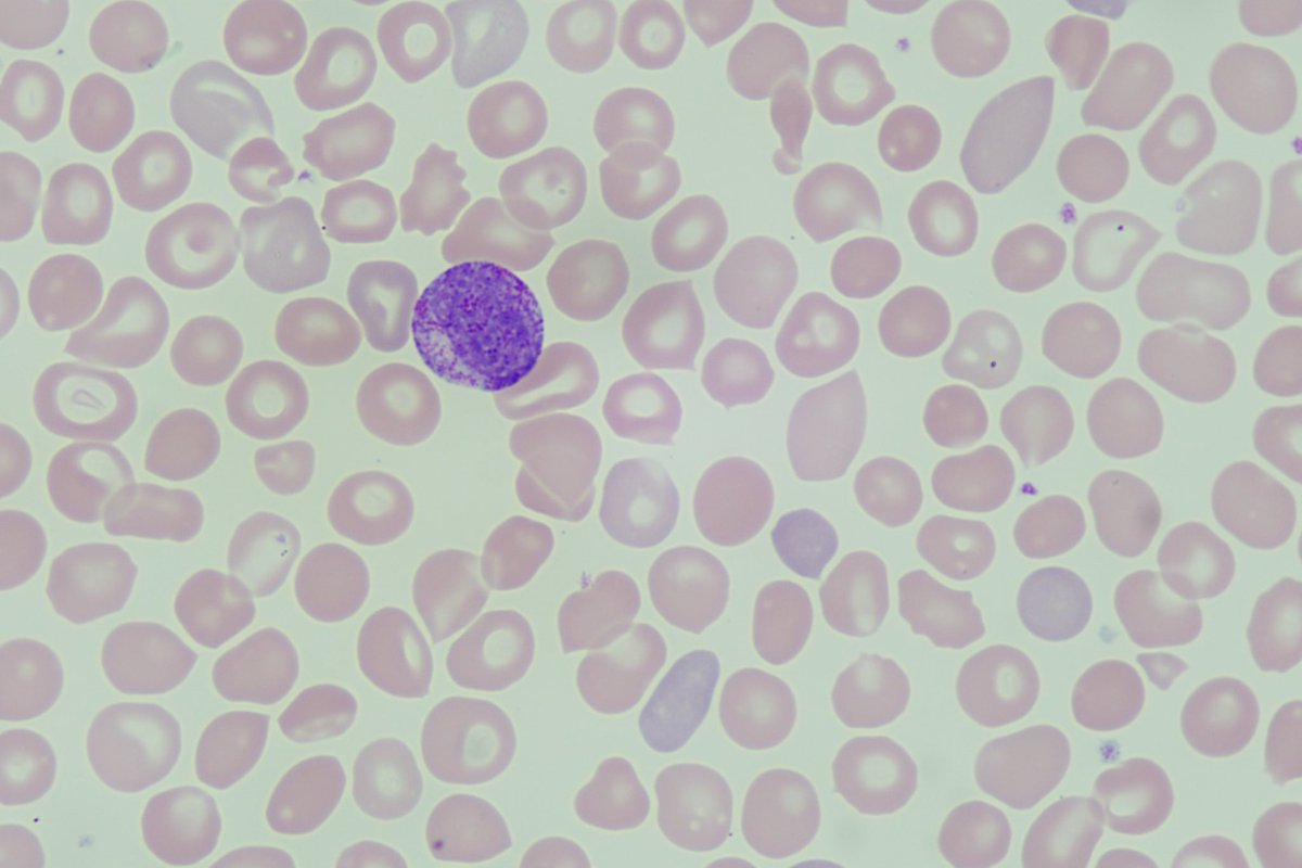 diff_discussion's tweet image. Do That Diff #6 features guest Toula @CastilloToula looking at some interesting cells with us youtu.be/D6T8KcQlBeo