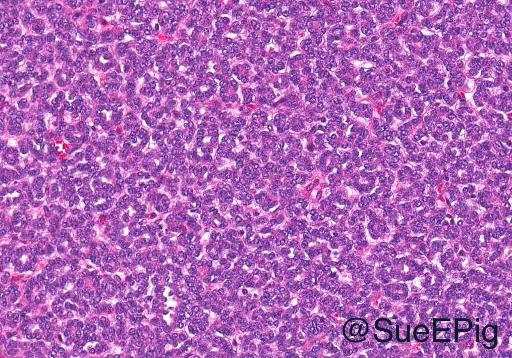 SueEPig's tweet image. Metanephric adenoma 
🔵 Cellular blue tumor composed of tightly packed tubules 
🔵 Sharp interface between tumor and surrounding renal parenchyma
🔵 PAX8/WT1/CD57/BRAF (+)
🔵 Diffdx: Papillary RCC, solid variant and epithelial predominant Wilms tumor #kidneytumor #beautyinbenign