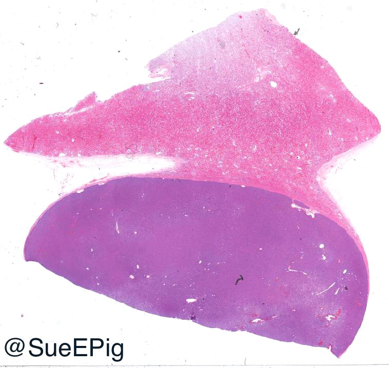 SueEPig's tweet image. Metanephric adenoma 
🔵 Cellular blue tumor composed of tightly packed tubules 
🔵 Sharp interface between tumor and surrounding renal parenchyma
🔵 PAX8/WT1/CD57/BRAF (+)
🔵 Diffdx: Papillary RCC, solid variant and epithelial predominant Wilms tumor #kidneytumor #beautyinbenign