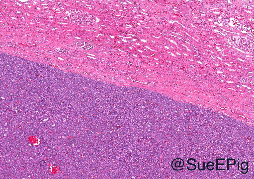 SueEPig's tweet image. Metanephric adenoma 
🔵 Cellular blue tumor composed of tightly packed tubules 
🔵 Sharp interface between tumor and surrounding renal parenchyma
🔵 PAX8/WT1/CD57/BRAF (+)
🔵 Diffdx: Papillary RCC, solid variant and epithelial predominant Wilms tumor #kidneytumor #beautyinbenign